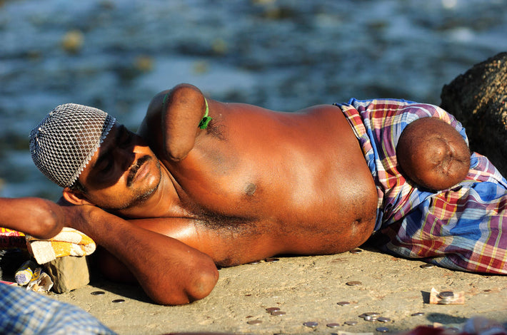 Man Missing Limbs, Begging, Mumbai